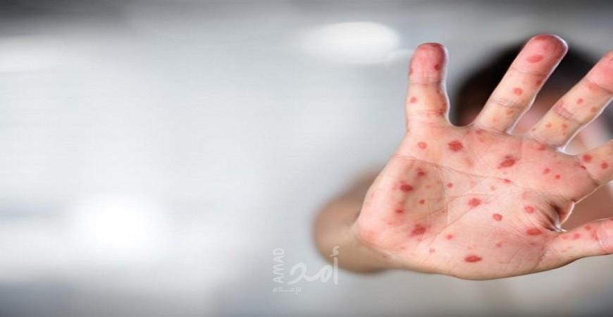الصحة  في غزة تشرع بحملة تطعيم ضد مرض الحصبة