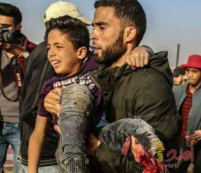 الصحة: 21 حالة بتر من مصابي مسيرة العودة منذ يوم الأرض