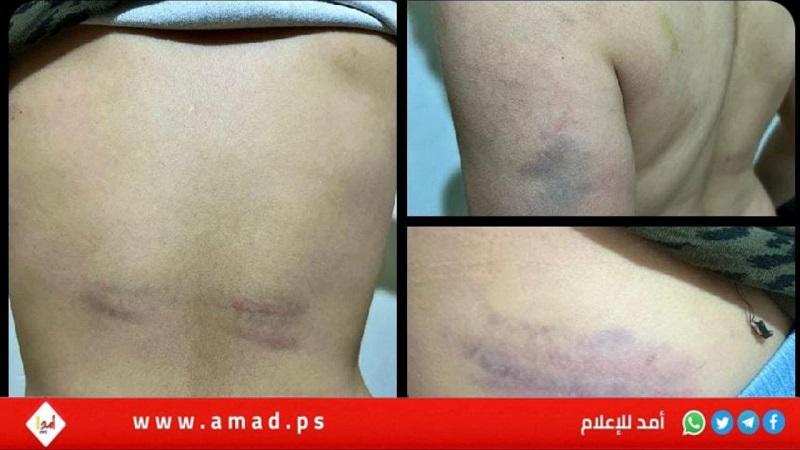 غزة: مدرس يعتدي على الطفل "أحمد الحلاق" بوحشية.. والعائلة تطالب بمحاسبته