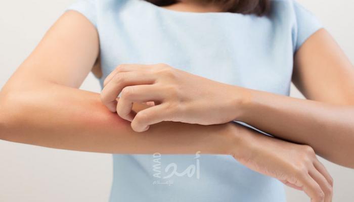 الحكة: أسبابها وأنواعها وأعراضها وعلاجها