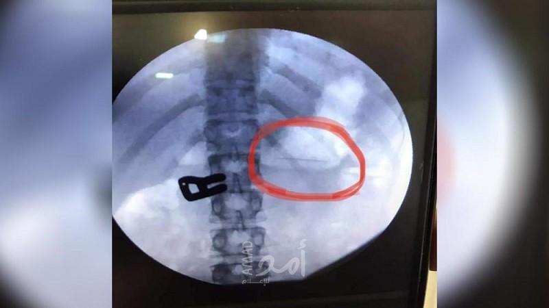 غزة: استخراج دبوس بطول 2سم بالمنظار من معدة فتاة