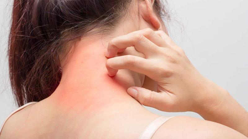 طرق العلاج والوقاية من الاكزيما