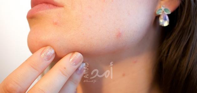 علاجات منزلية لحبوب الوجه الحمراء