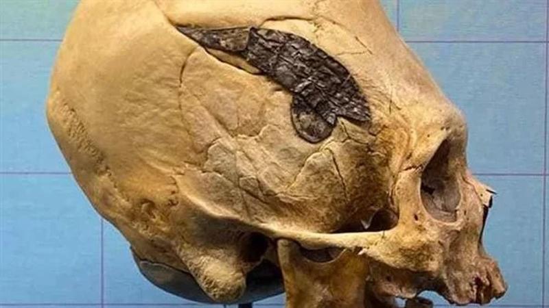العثور على أول جمجمة خضعت لعملية جراحية منذ 2000 عام