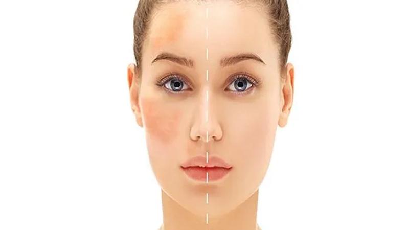 طرق طبيعية لعلاج الكلف