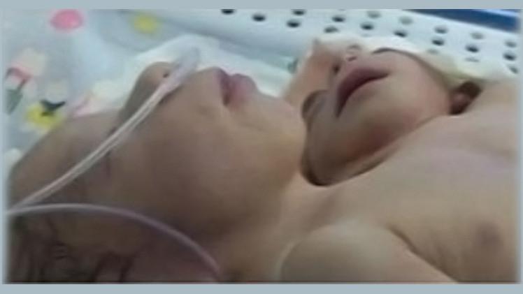 طفل مصري يولد في المنوفية برأسين وقلبين وثلاث أذرع