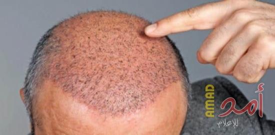 طبيبة بريطانية: عمليات زرع الشعر ليست الحل الأمثل وغير مجدية