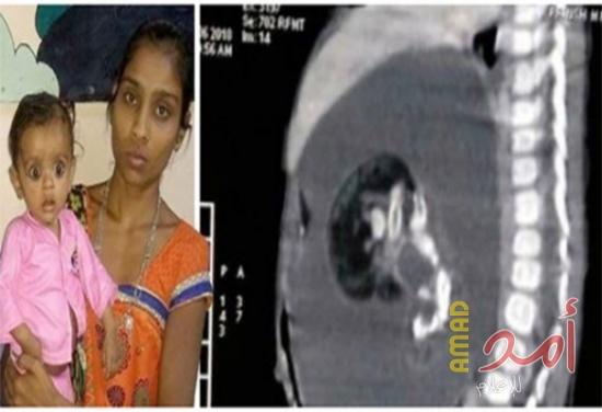 حالة نادرة لجنين ينمو داخل طفلة كاد أن يودي بحياتها