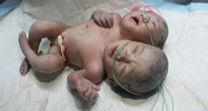 ولادة توأم ملتصق في مدينة غزة