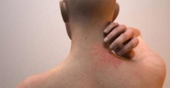 علاقة بين التوتر والإجهاد ومشاكل الجلد .. تعرف