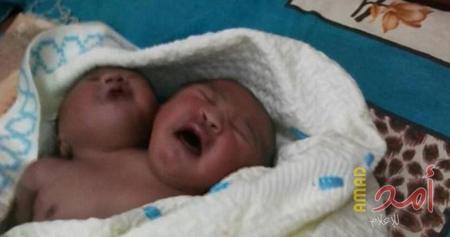 ولادة نادرة في مصر.. طفل برأسين وقلب واحد