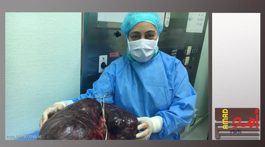 إزالة ورم يزن 17.5 كيلوغراما من بطن امرأة في دبي