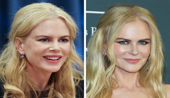 بالصور .. 10 نجمات يعترفن بإجراء عمليات تجميل أبرزهن نيكول كيدمان