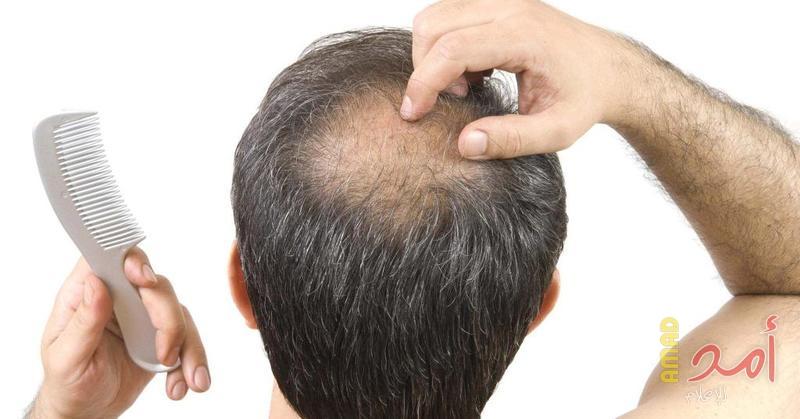 أهم وأحدث تقنيات زراعة الشعر في العالم