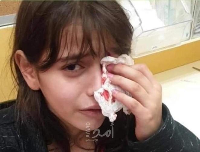 إصابة طفلة بعينها في هجوم للمستوطنين بالقدس