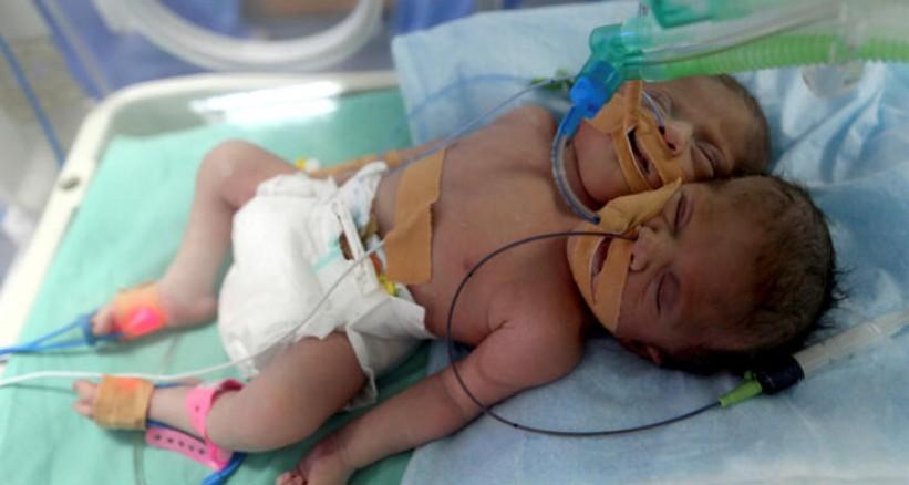 أطباء غزة يواجهون تحديا بعد ميلاد توأمتين ملتصقتين