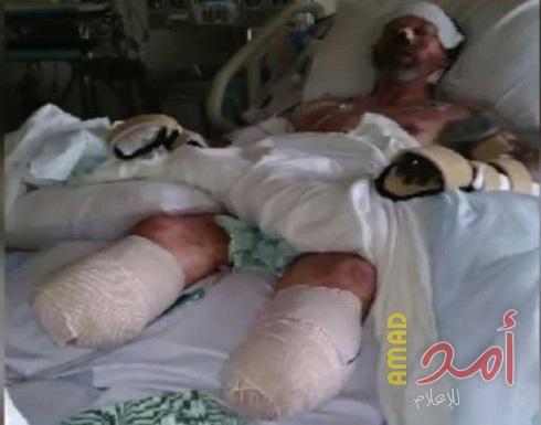 بالصورة : تحذير لمحبي الحيوانات الأليفة.. لعقه كلب فبتروا أطرافه