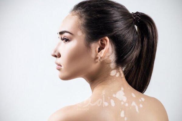 أعراض وأسباب  وعلاج مرض البهاق