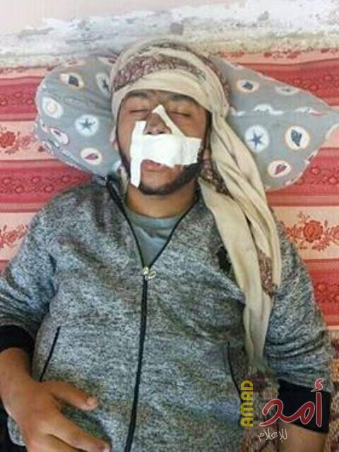 إصابة الشاب "هزاع البحيصي" بكسور في اليد والأسنان  جراء اعتداء أجهزة أمن حماس عليه