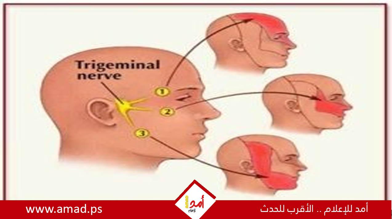 علامات الإصابة بالتهاب العصب ثلاثي التوائم