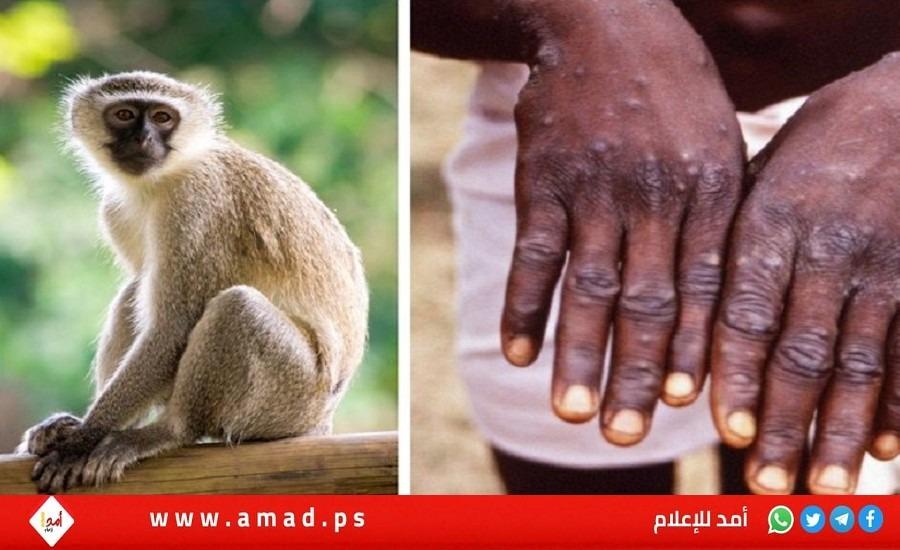 الصحة: فلسطين خالية من فيروس جدري القرود