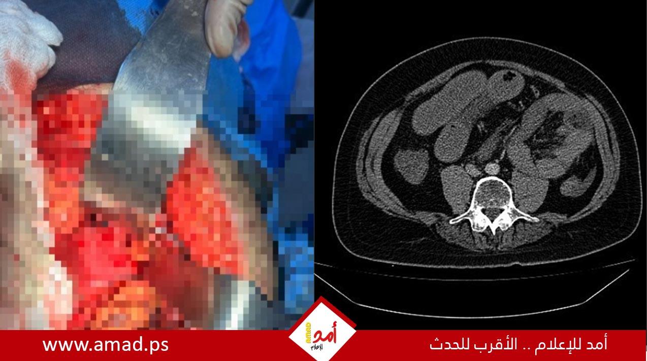 إنجاز طبي في ظروف صعبة.. السرايا الميداني ينقذ شابًا من حالة جراحية نادرة - تفاصيل