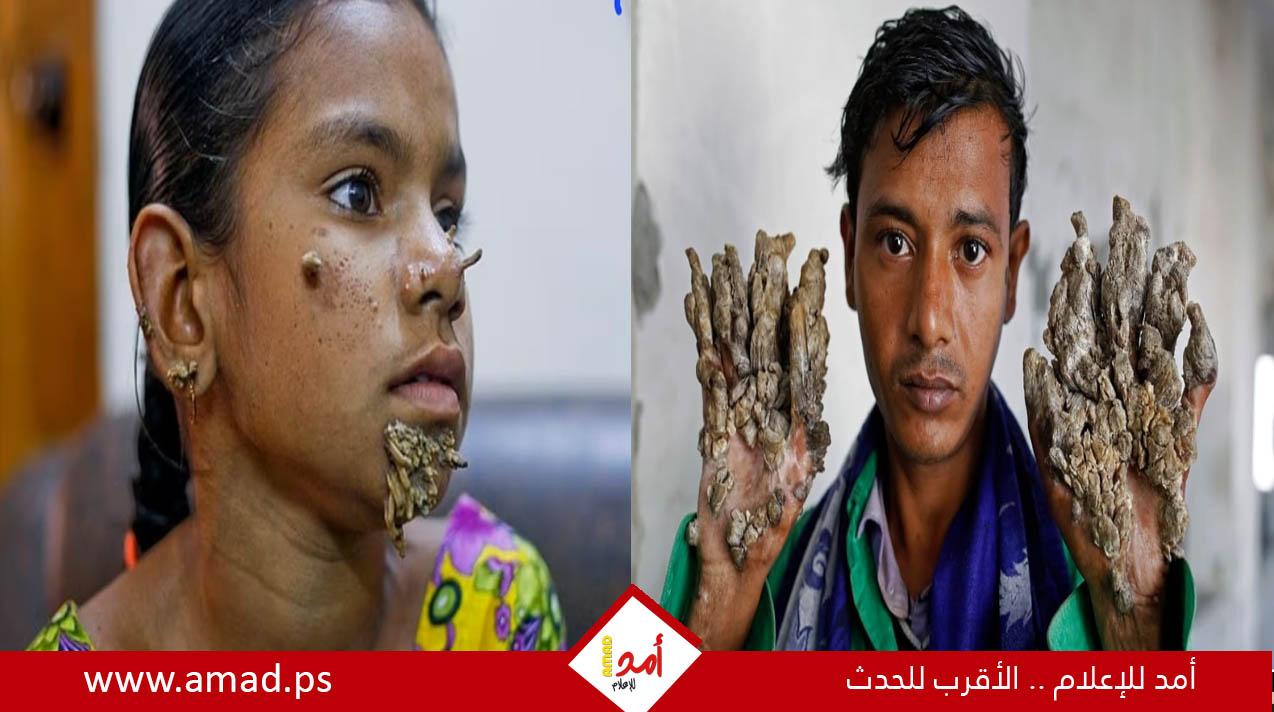 مرض نادر يحول جلد المصابين ليشبه أغصان الشجر - تفاصيل