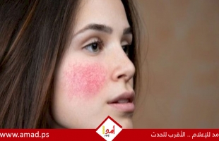 تخلصي من حبوب الشباب قبل العيد