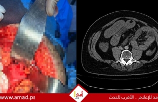 إنجاز طبي في ظروف صعبة.. السرايا الميداني ينقذ شابًا من حالة جراحية نادرة - تفاصيل